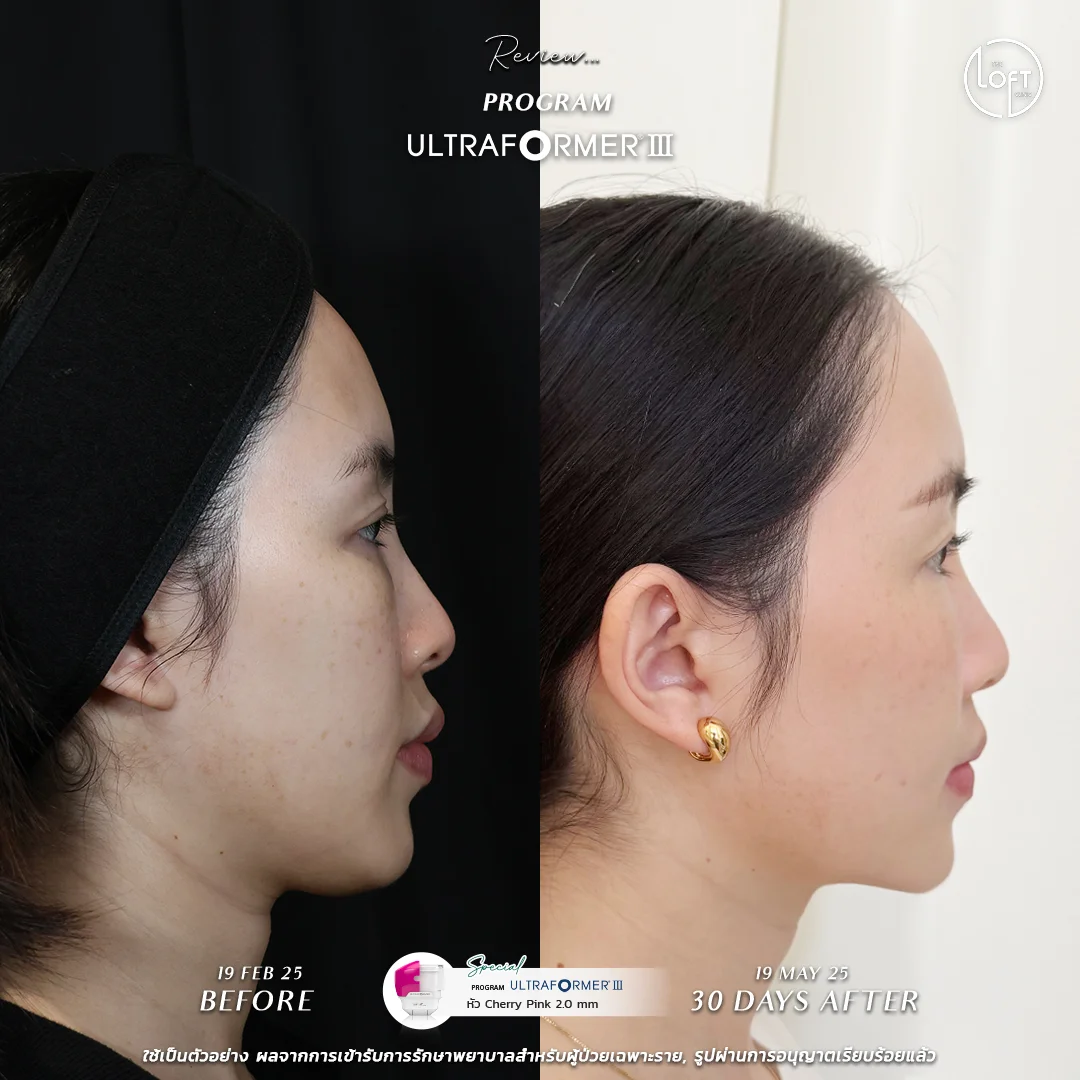 รีวิว 5 การทำ Program Ultraformer III