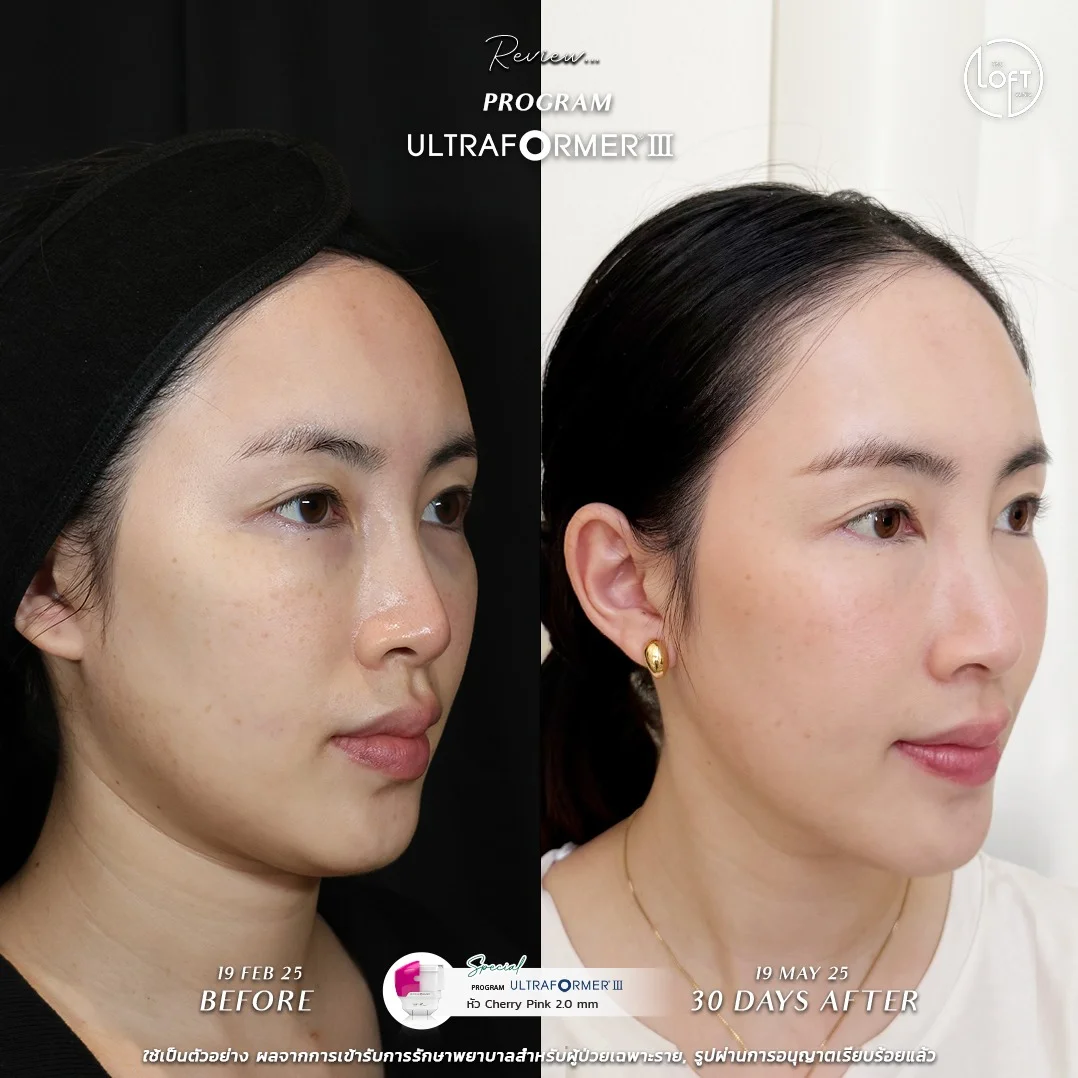 รีวิว 4 การทำ Program Ultraformer III