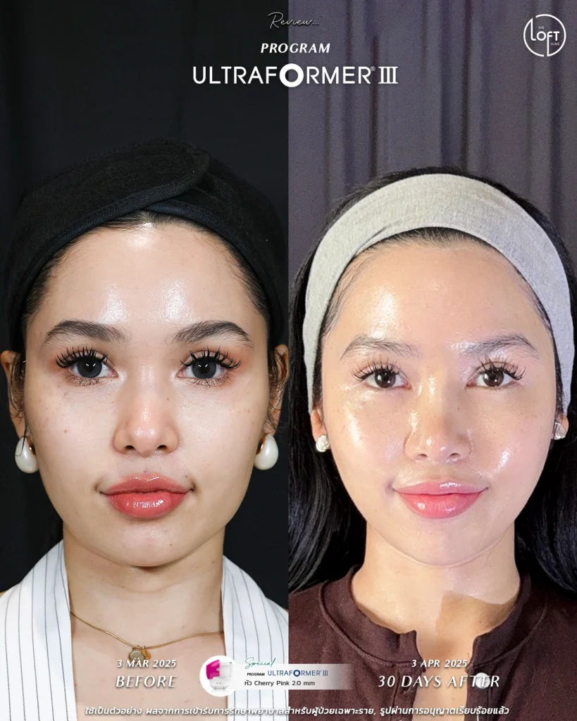 รีวิว program ultraformer III