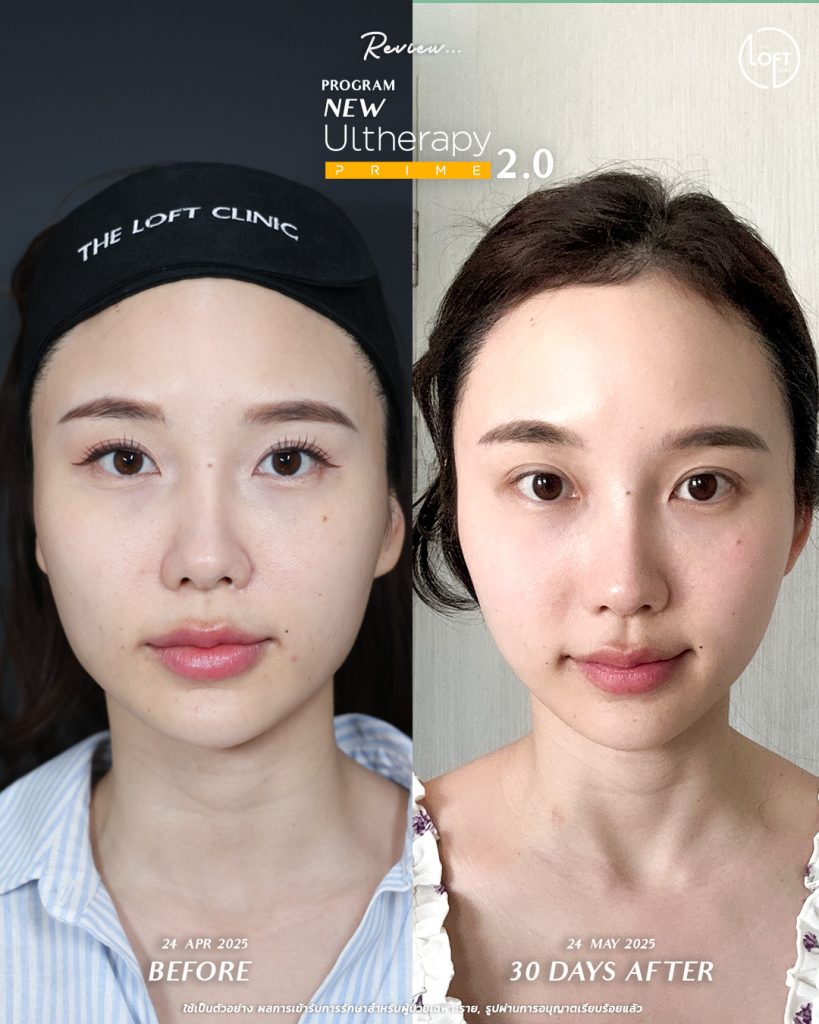 รีวิว program new ultherapy