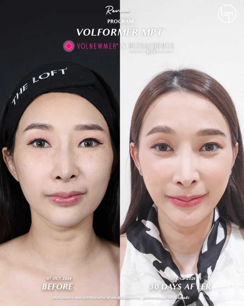 รีวิว program volnemer X ultraormer