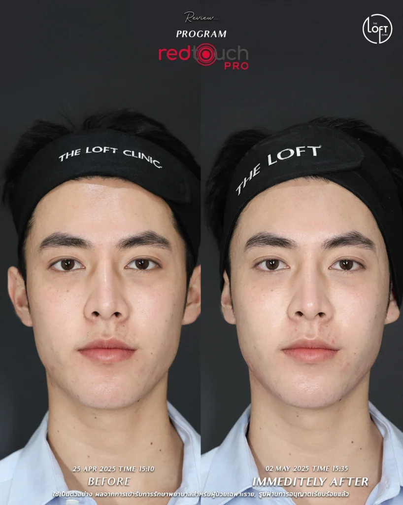 รีวิว program redtouch