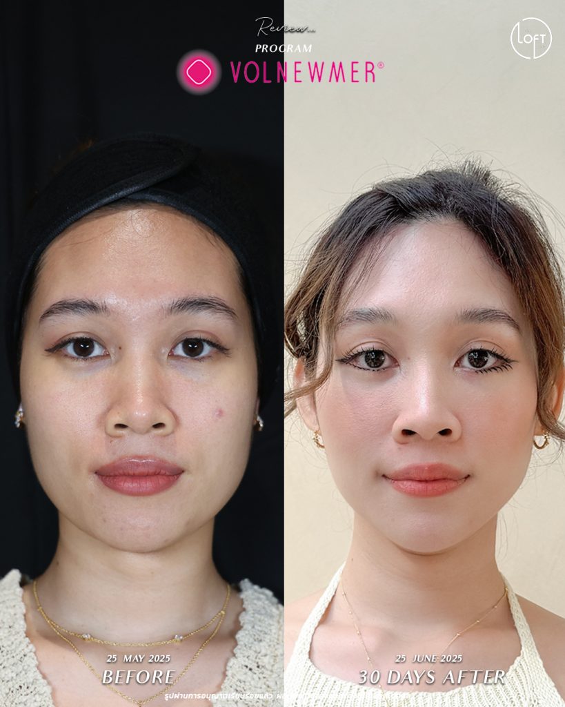 รีวิว program volnemer