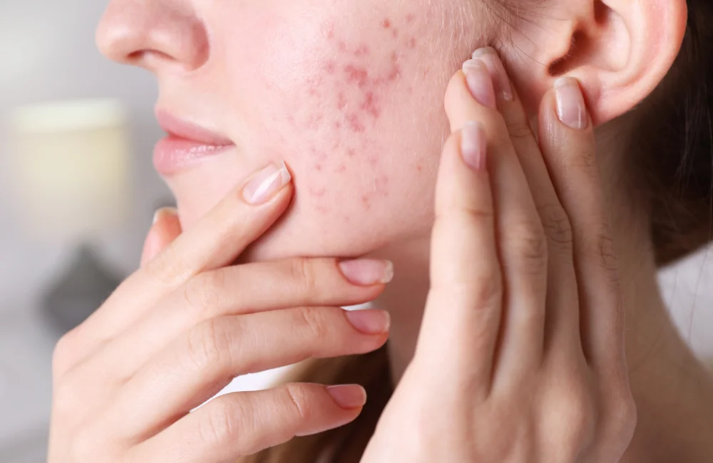 เลเซอร์รอยสิว ทำให้หน้าบางจริงไหม