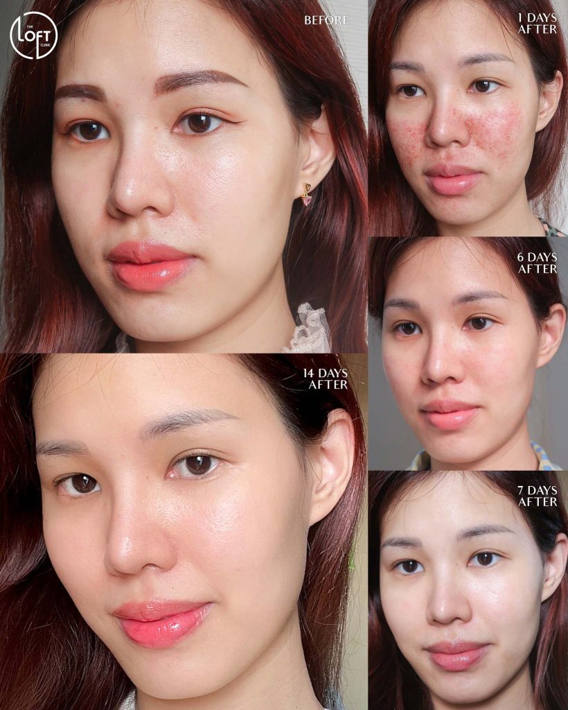 รีวิวเลเซอร์หน้าใส