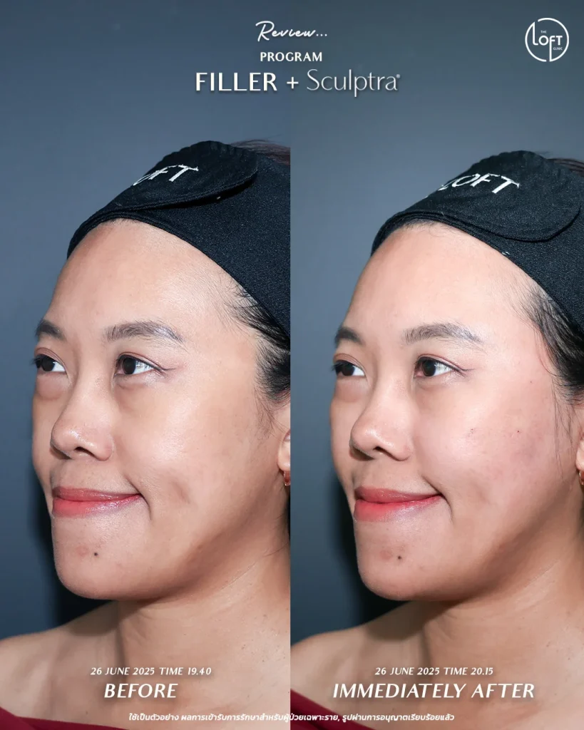 รีวิวฟิลเลอร์