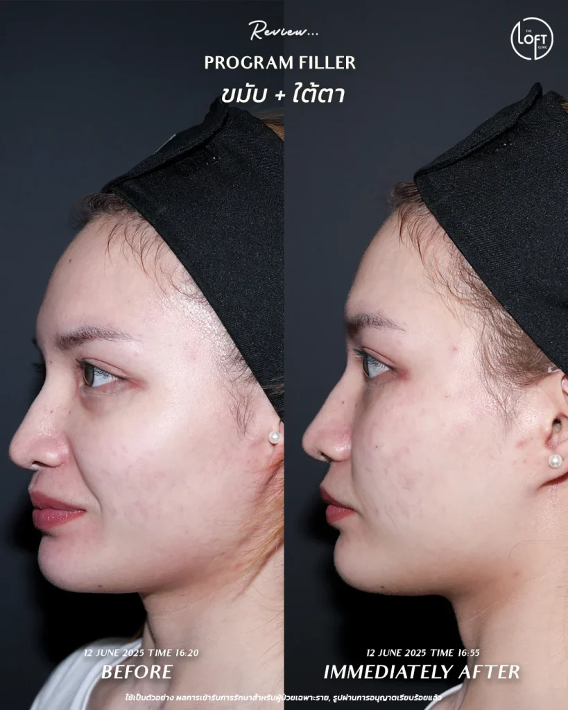 รีวิวฟิลเลอร์