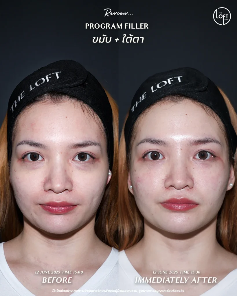 รีวิวฟิลเลอร์