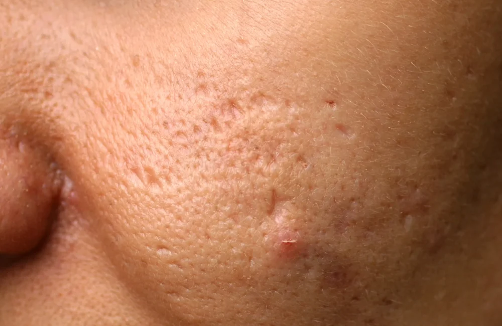 Ice Pick Scars (หลุมสิวแบบจิก)