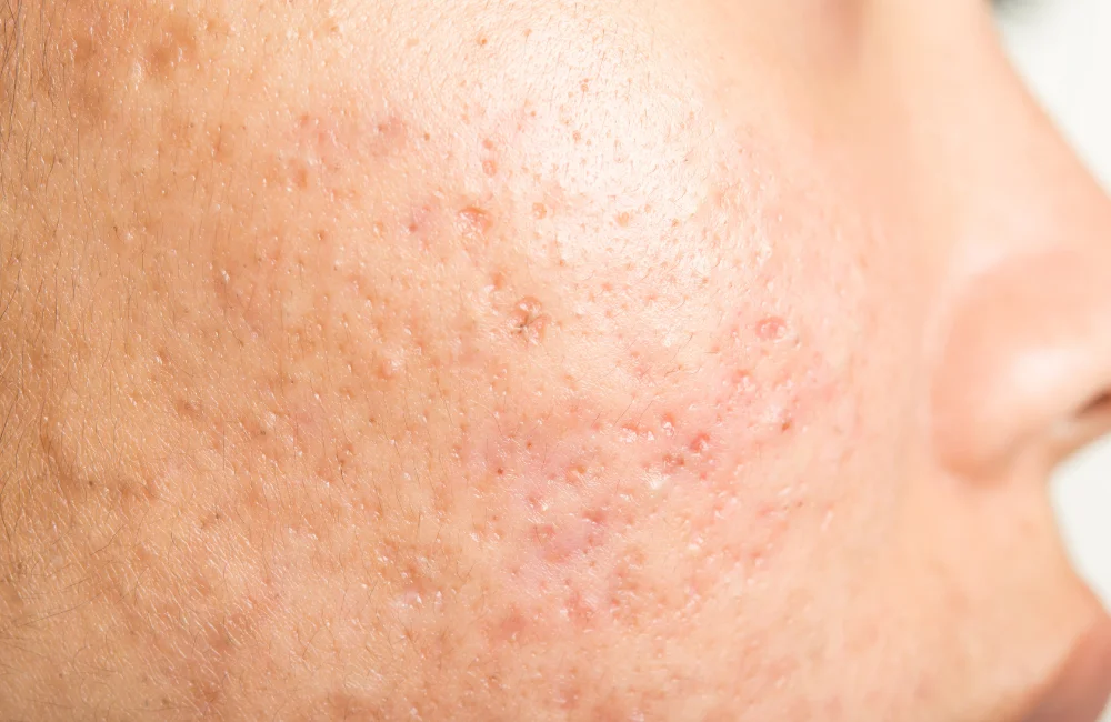 Rolling Scars (หลุมสิวแบบแอ่งคลื่น/แอ่งกระทะ)