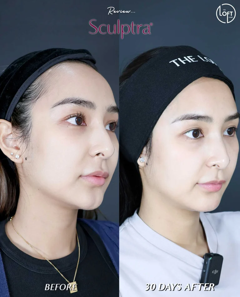 รีวิว Program Sculptra
