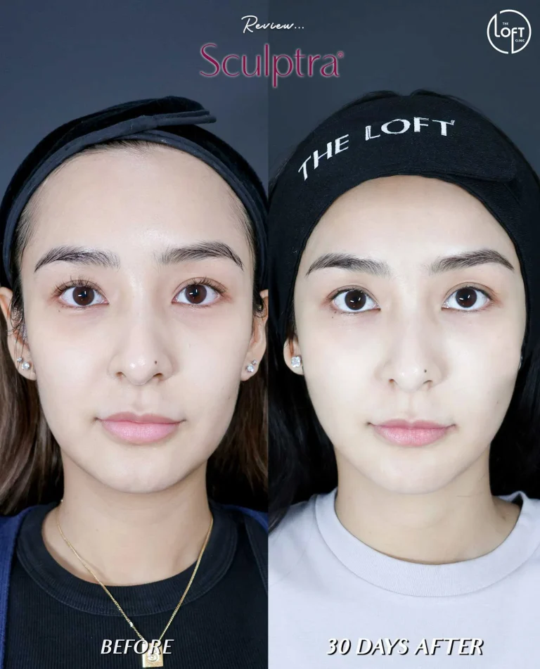 รีวิว Program Sculptra