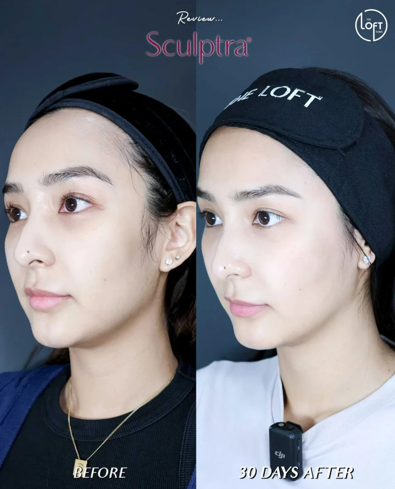 รีวิว Program Sculptra