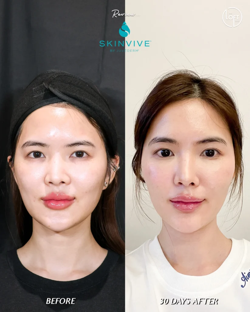 รีวิว Program Skinvive