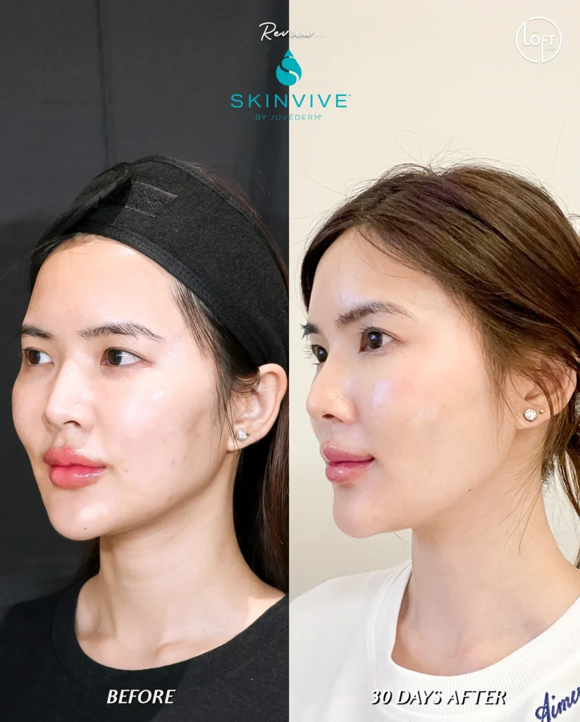 รีวิว Program Skinvive