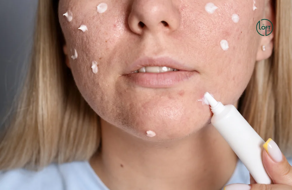 การรักษาสิวฮอร์โมน