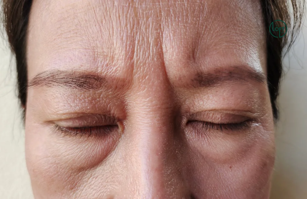 บริเวณที่เกิดริ้วรอยบนใบหน้าได้ง่าย