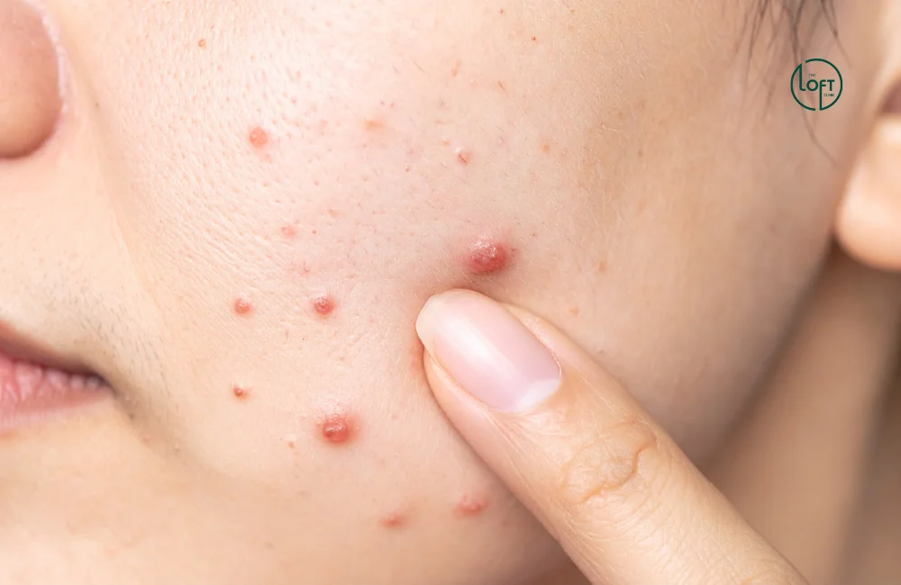 สิวอักเสบรักษายังไง