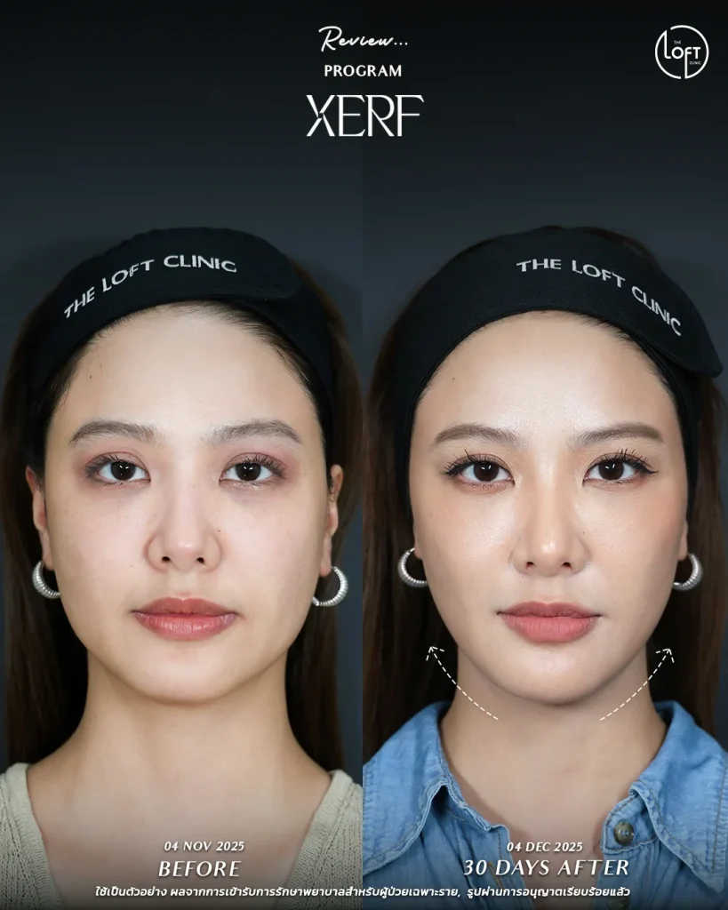 LINE_ALBUM_รีวิว K.นิ้ง Xerf_251217_1