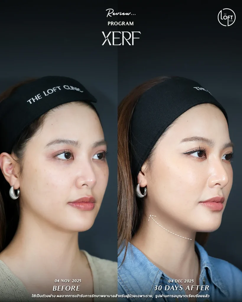 LINE_ALBUM_รีวิว K.นิ้ง Xerf_251217_2