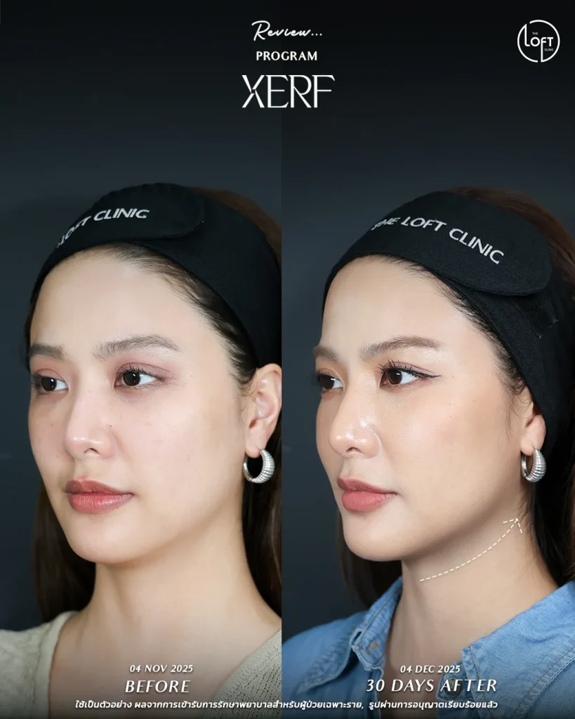 LINE_ALBUM_รีวิว K.นิ้ง Xerf_251217_3