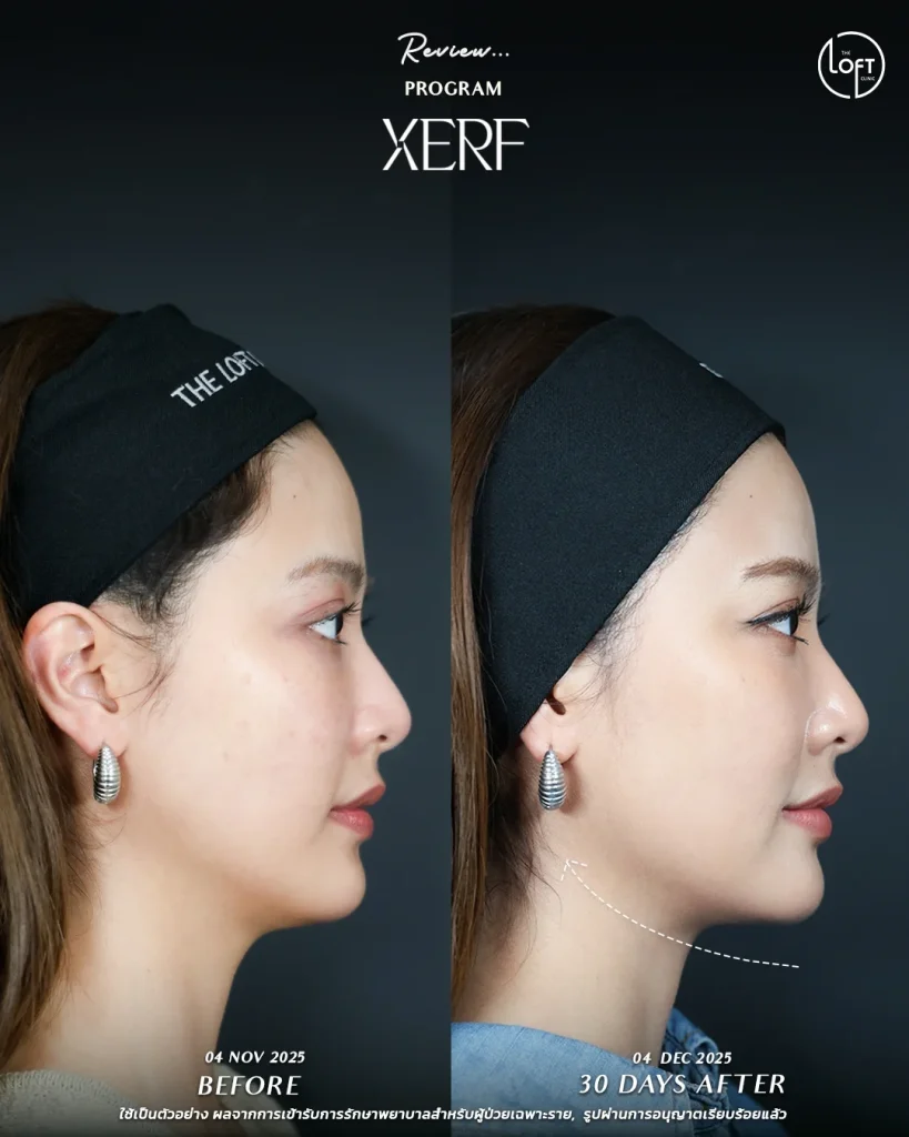 LINE_ALBUM_รีวิว K.นิ้ง Xerf_251217_4