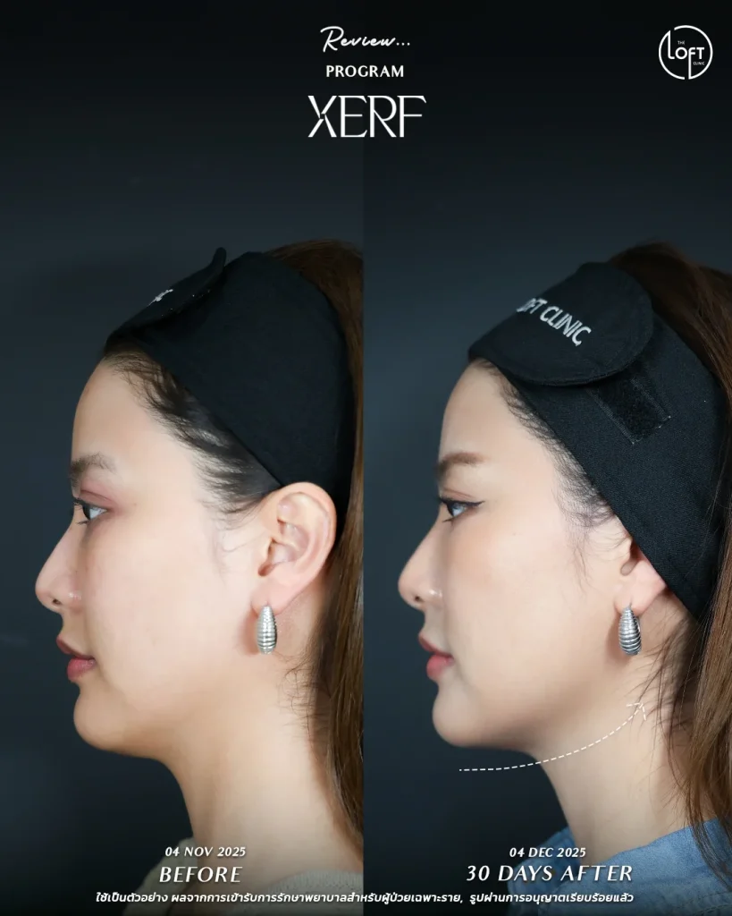 LINE_ALBUM_รีวิว K.นิ้ง Xerf_251217_5