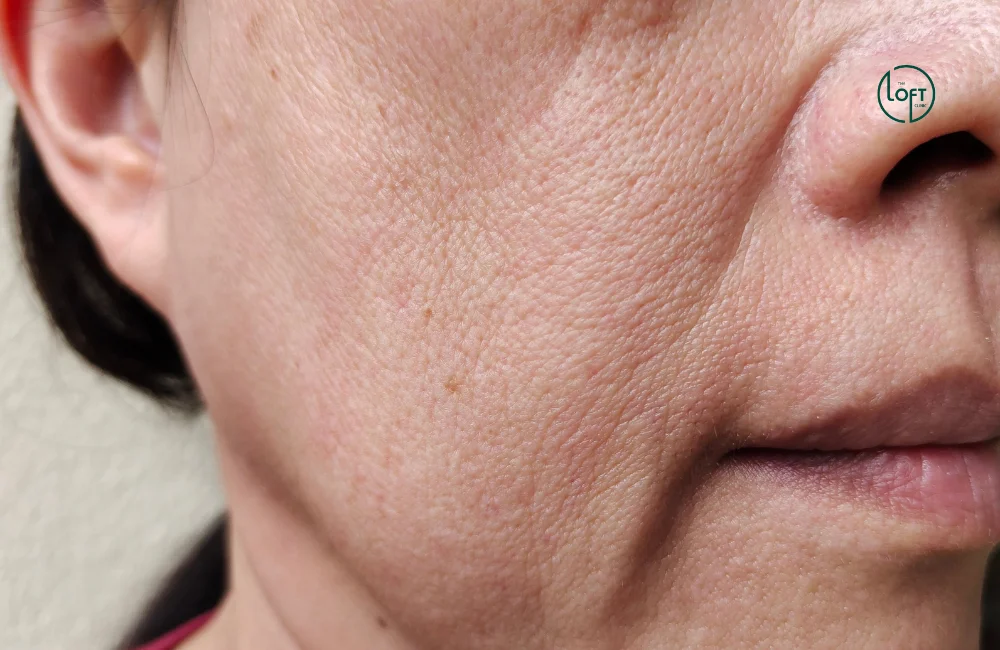 แก้ปัญหาร่องแก้มลึก