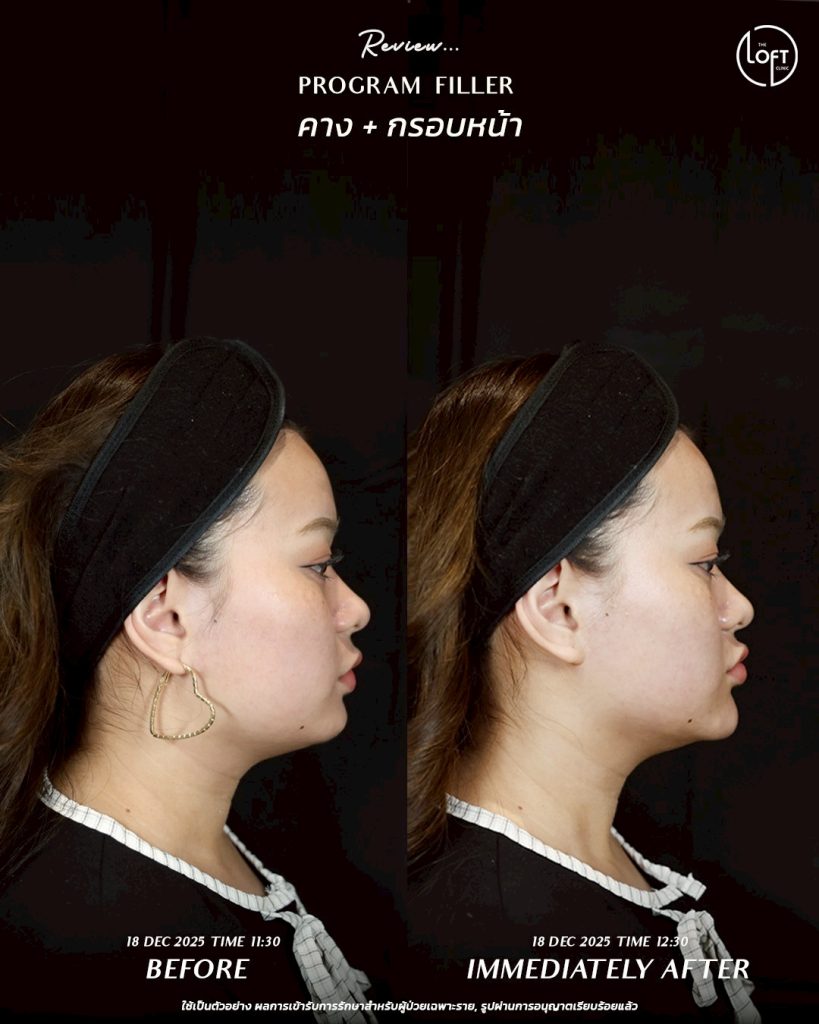 LINE_ALBUM_รีวิว Filler k.ข้าวตู_260127_1