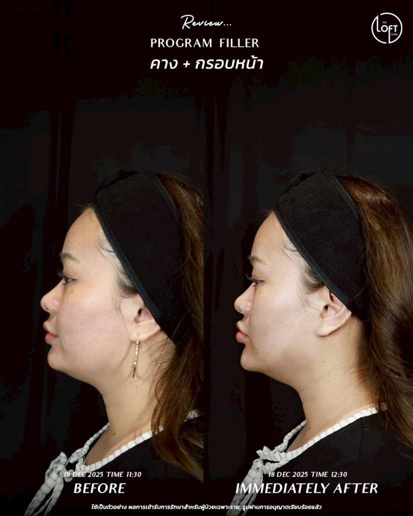 LINE_ALBUM_รีวิว Filler k.ข้าวตู_260127_2