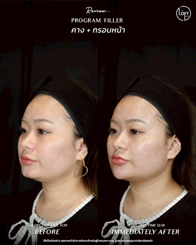 LINE_ALBUM_รีวิว Filler k.ข้าวตู_260127_3