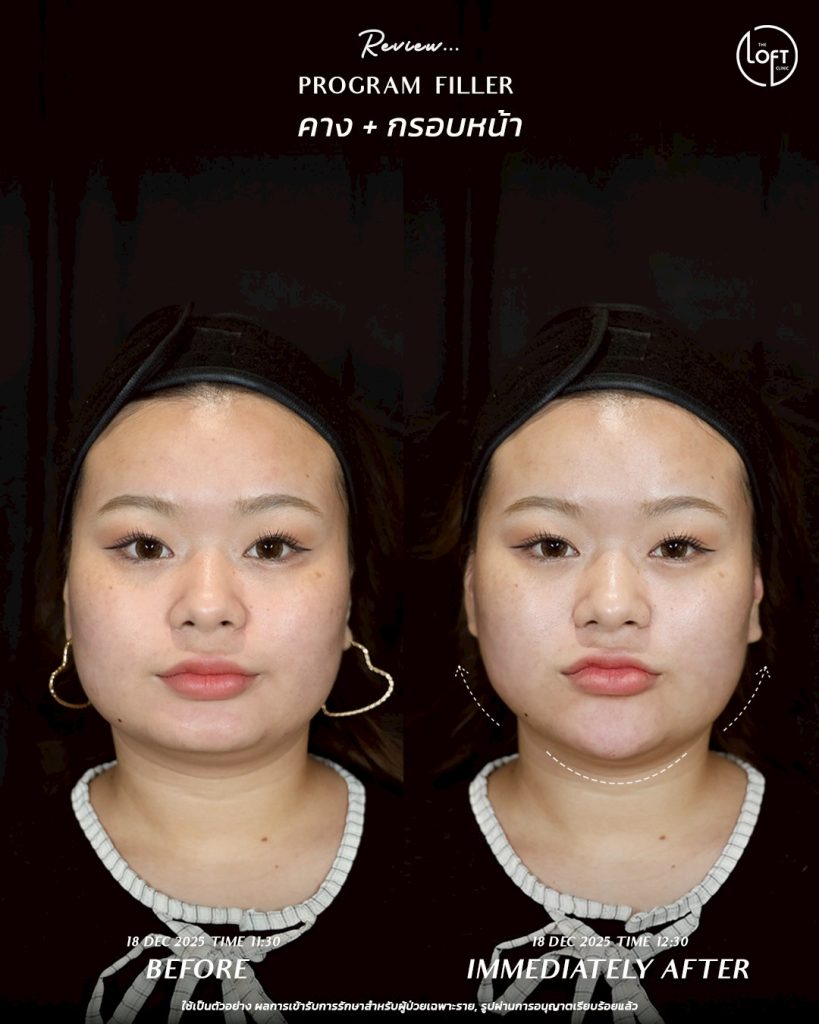 LINE_ALBUM_รีวิว Filler k.ข้าวตู_260127_4