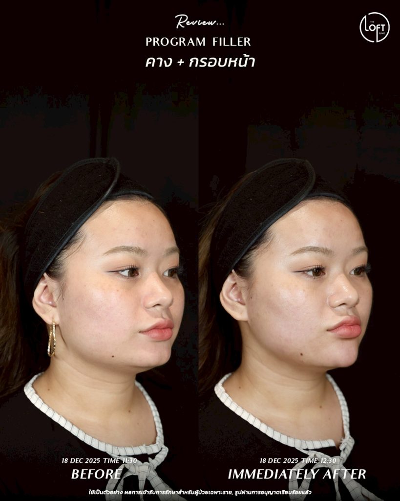 LINE_ALBUM_รีวิว Filler k.ข้าวตู_260127_5