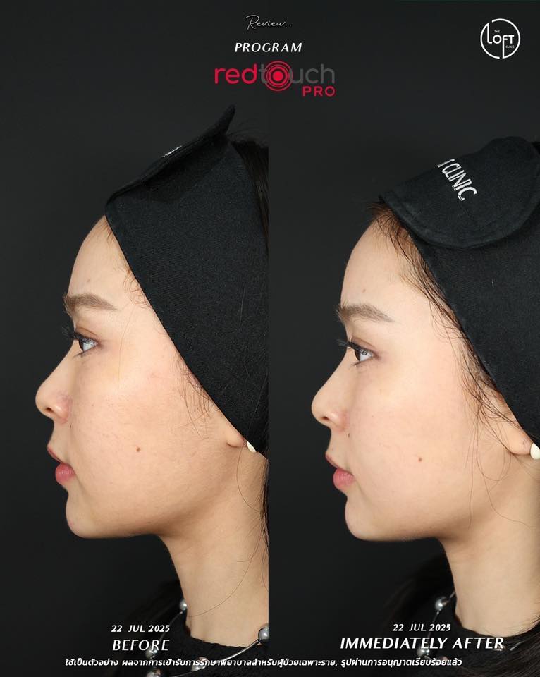 "รีวิวก่อนทำและทันทีหลังทำเลเซอร์ RedTouch Pro ผิวหน้าเรียบเนียนกระจ่างใสขึ้นทันที ไม่ต้องพักหน้า - The Loft Clinic"