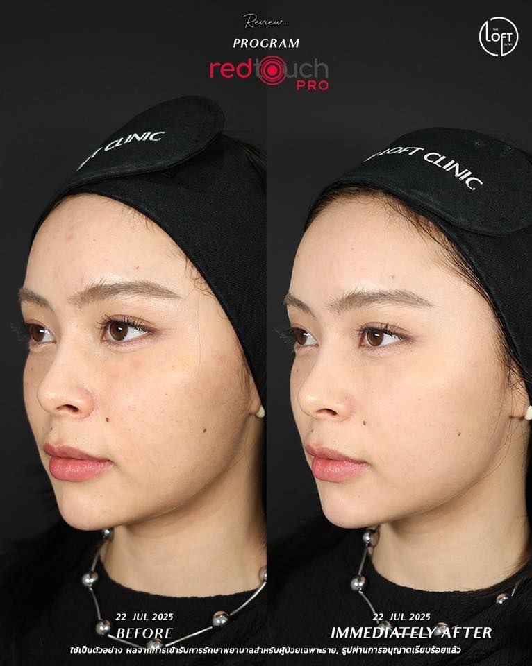 "รีวิวก่อนทำและทันทีหลังทำเลเซอร์ RedTouch Pro ผิวหน้าเรียบเนียนกระจ่างใสขึ้นทันที ไม่ต้องพักหน้า - The Loft Clinic"