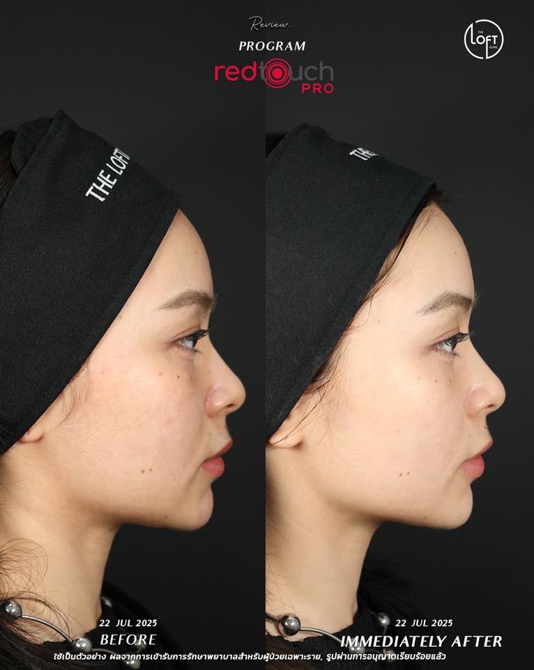 "รีวิวก่อนทำและทันทีหลังทำเลเซอร์ RedTouch Pro ผิวหน้าเรียบเนียนกระจ่างใสขึ้นทันที ไม่ต้องพักหน้า - The Loft Clinic"