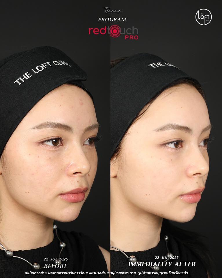 "รีวิวก่อนทำและทันทีหลังทำเลเซอร์ RedTouch Pro ผิวหน้าเรียบเนียนกระจ่างใสขึ้นทันที ไม่ต้องพักหน้า - The Loft Clinic"