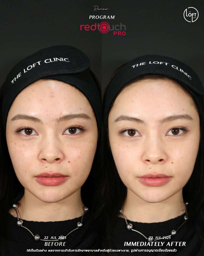 "รีวิวก่อนทำและทันทีหลังทำเลเซอร์ RedTouch Pro ผิวหน้าเรียบเนียนกระจ่างใสขึ้นทันที ไม่ต้องพักหน้า - The Loft Clinic"