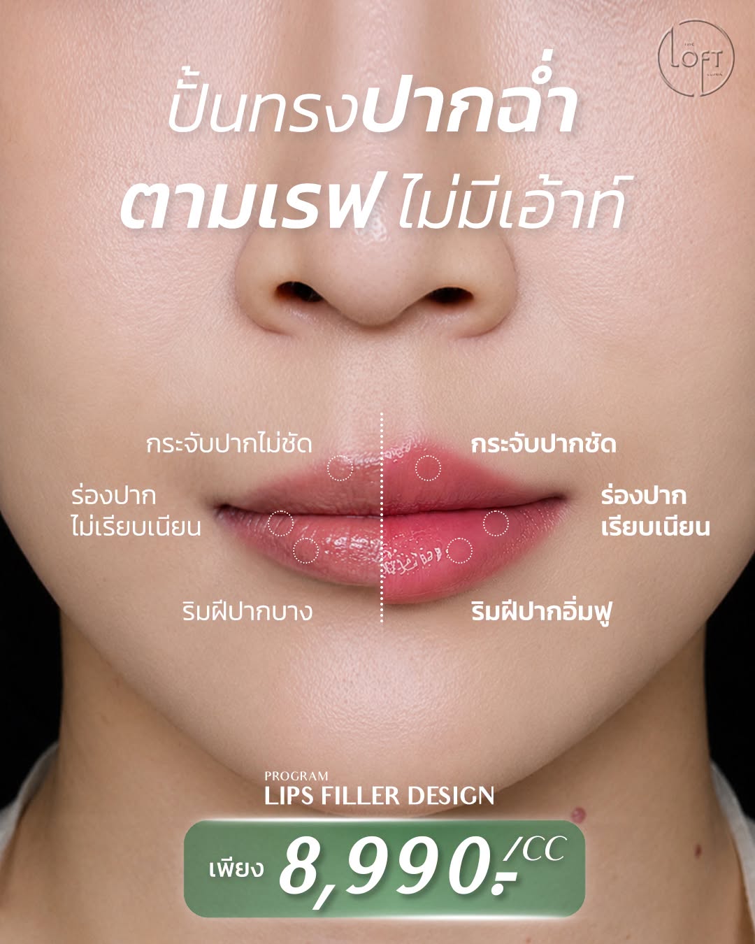 "โปรแกรมฟิลเลอร์ปาก Lips Filler Design ที่ The Loft Clinic ปั้นทรงปากฉ่ำ กระจับปากชัด ร่องปากเรียบเนียน ริมฝีปากอิ่มฟู ราคา 8,990 บาทต่อซีซี"