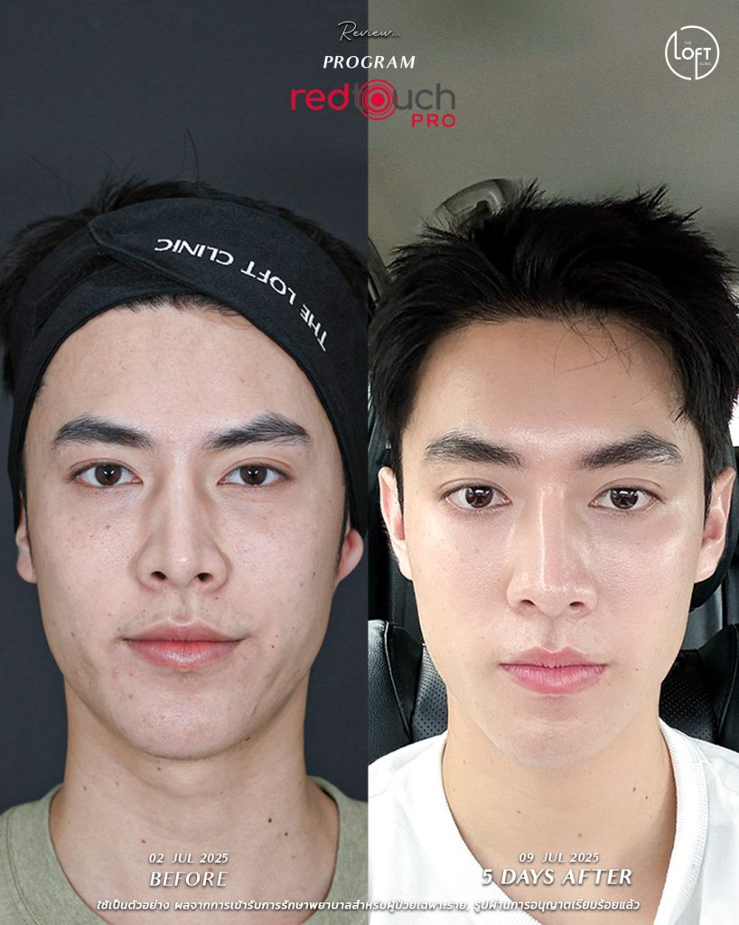 "รีวิวก่อน-หลังทำเลเซอร์ RedTouch Pro ที่ The Loft Clinic ผิวหน้ากระจ่างใสขึ้นภายใน 5 วัน"