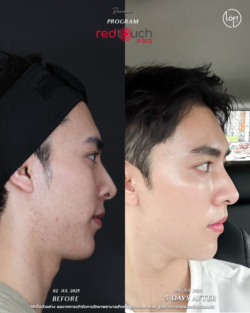 "รีวิวก่อน-หลังทำเลเซอร์ RedTouch Pro ที่ The Loft Clinic ผิวหน้ากระจ่างใสขึ้นภายใน 5 วัน"