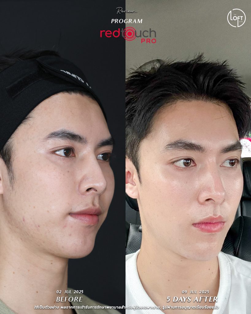 "รีวิวก่อน-หลังทำเลเซอร์ RedTouch Pro ที่ The Loft Clinic ผิวหน้ากระจ่างใสขึ้นภายใน 5 วัน"