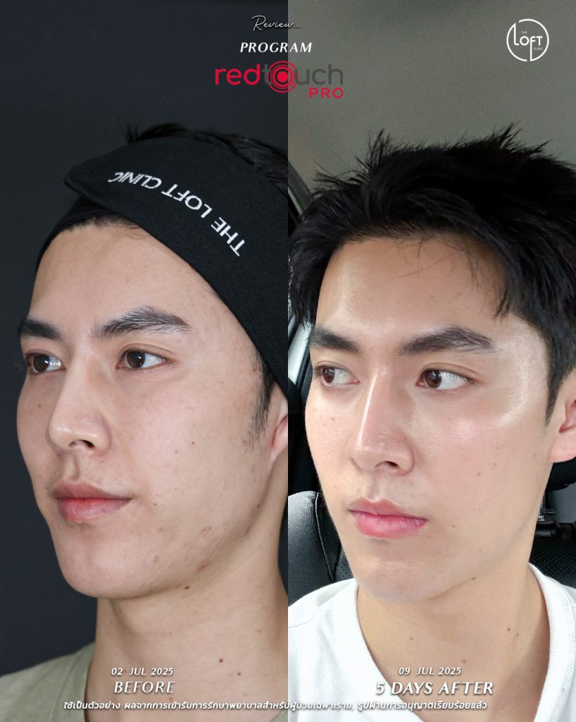 "รีวิวก่อน-หลังทำเลเซอร์ RedTouch Pro ที่ The Loft Clinic ผิวหน้ากระจ่างใสขึ้นภายใน 5 วัน"