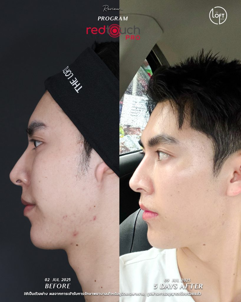 "รีวิวก่อน-หลังทำเลเซอร์ RedTouch Pro ที่ The Loft Clinic ผิวหน้ากระจ่างใสขึ้นภายใน 5 วัน"