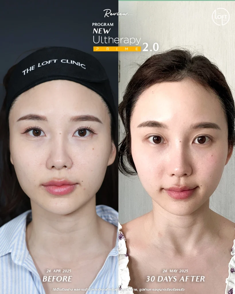รีวิวเทียบภาพโปรแกรม Ulthera