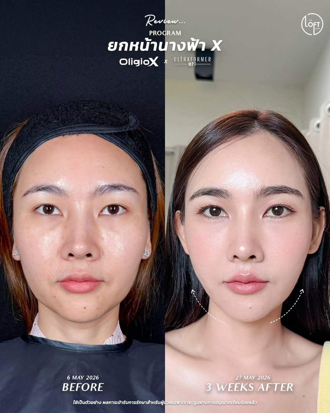 "รีวิวโปรแกรมยกหน้านางฟ้า X (OligioX คู่กับ Ultraformer MPT) ที่ The Loft Clinic ก่อนทำและหลังทำ 3 สัปดาห์ มุมด้านหน้าเห็นหน้าเรียววีเชป กรอบหน้ายกกระชับ ผิวดูกระจ่างใสขึ้น"